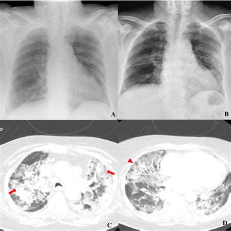 Chest X Ray Showing Bilateral Ground Glass Opacities Related To Download Scientific Diagram