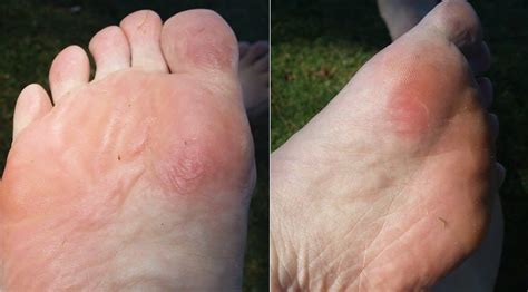 Blister Healing Time: How Long Does It Take For A Blister To Heal ...