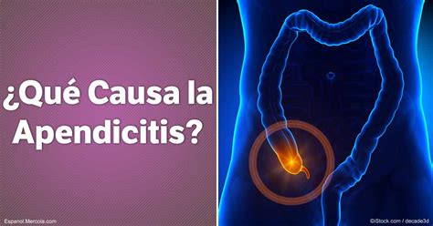 Vive Sana Causas Que Pueden Provocar Apendicitis