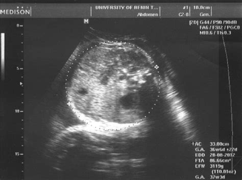 fetal abdominal sonogram  measurement  abdominal circumference