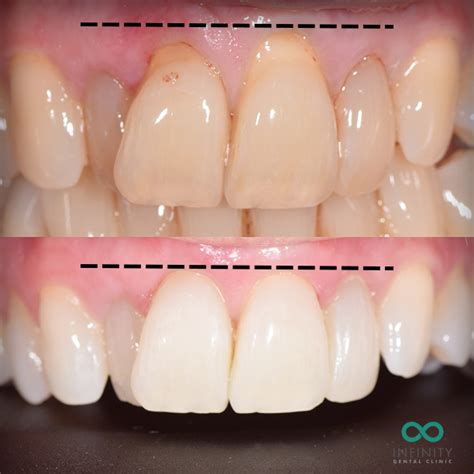 Treating receding gums - Infinity Dental Clinic Leeds