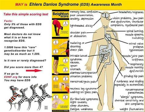 Pin By Colleen Archbold On Ehlers Danlos Ehlers Danlos Syndrome