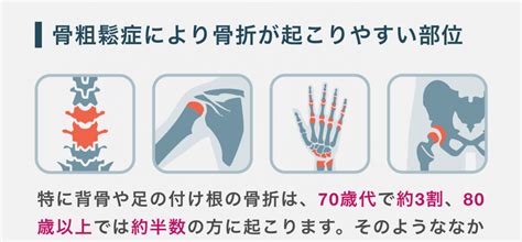 骨粗鬆症 部位・症例解説 森整形外科｜愛知県一宮市の整形外科・リハビリ｜ネット予約対応