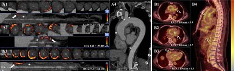 Perivascular Fat Attenuation Index Mapping And Tracking Immunoglobulin