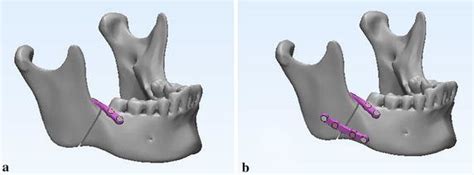 Two Typical Fixation Systems For Mandibular Angle Fracture A Type A