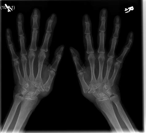 Oa Hands Rheumexam Atlas