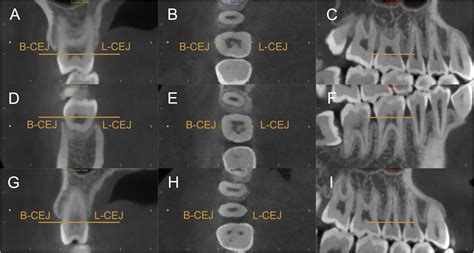 A Preliminary Study Of Buccal And Lingual Alveolar Bone Thickness Of