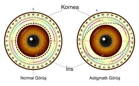 Astigmat Nedir Belirtileri Nelerdir A N G Z Hastanesi Zel