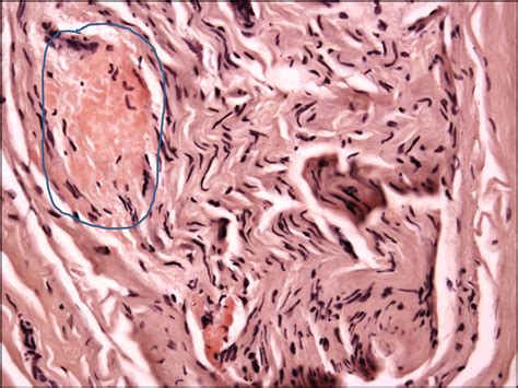 neuropathology blog: Amyloid neuropathy in a middle-aged man