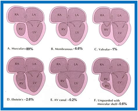 Tricuspid Atresia Types