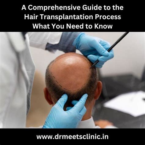 hair transplantation  indore process