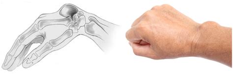 Ganglion Cysts FORM Hand, Wrist Elbow Institute, 40% OFF