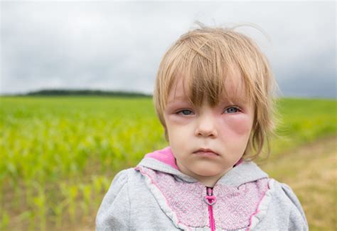 Gesichtsschwellung Ursachen Behandlung Und Hausmittel