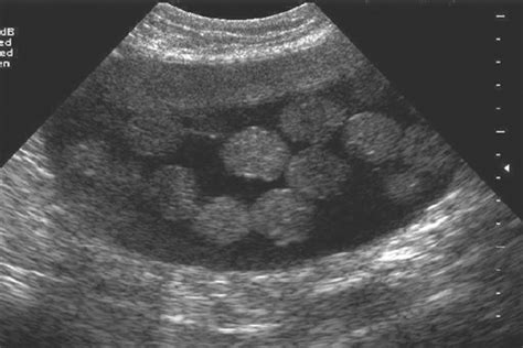 Ovarian Cystic Teratoma Ultrasound