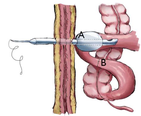 Application Of Spontaneously Closing Cannula Ileostomy In Laparoscopic