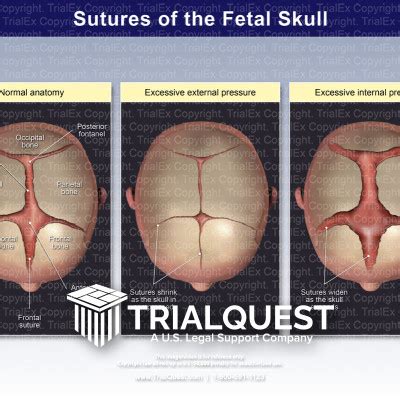 Sutures of the Fetal Skull - TrialExhibits Inc.