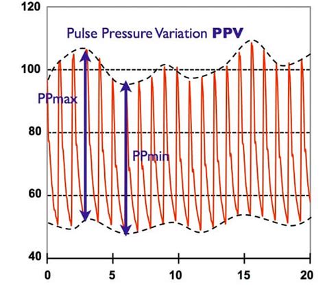 Pulse Pressure - The Definitive Guide | Biology Dictionary