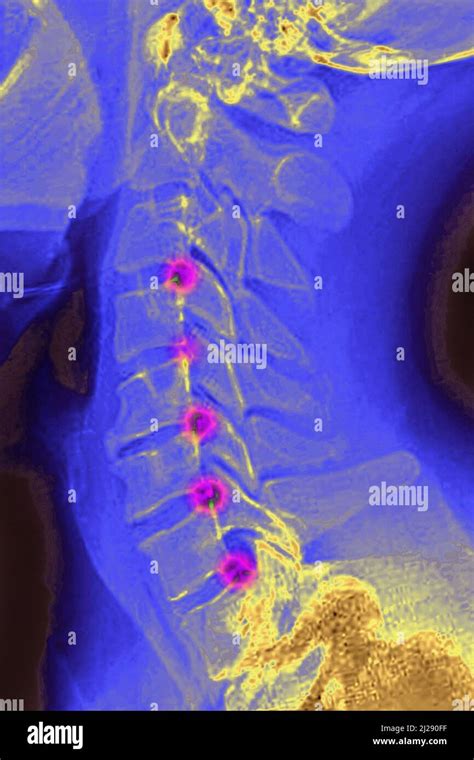 Halswirbels Ule Arthrose Fotos Und Bildmaterial In Hoher Aufl Sung