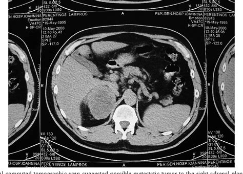 Figure 1 From Laparoscopic Adrenalectomy For Large Adrenal Metastasis