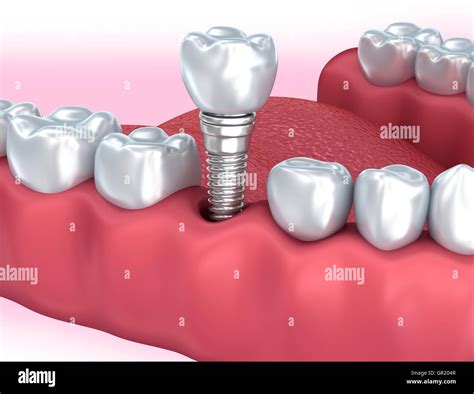 Tooth Human Implant Medically Accurate 3d Illustration Stock Photo Alamy