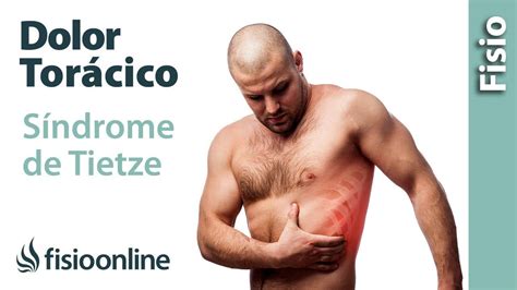 Síndrome de TIETZE Qué es y cuál es su tratamiento FisioOnline