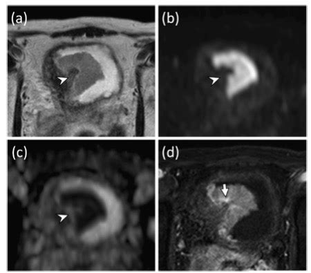 European Radiology VI RADS在肌层浸润性膀胱癌多模式治疗中的新用途 MedSci cn