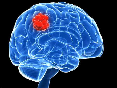 Heres Why Childhood Brain Tumour Survivors Can Be Prone To Heart