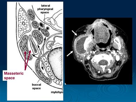 Ppt Odontogenic Infection Pathway Powerpoint Presentation Free Download Id 9193237