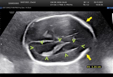 Typical Ultrasound Features In Open Spina Bifida [january 2022] Efsumb