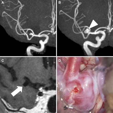 Vessel Wall Imaging Of Evolving Unruptured Intracranial Aneurysms Stroke