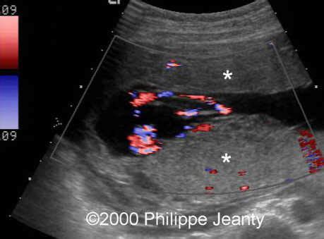 Succenturiate Lobe Placenta Ultrasound