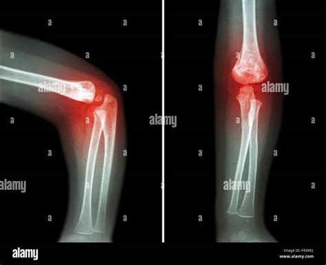 Arthritis As Related To Gouty Arthritis Pictures