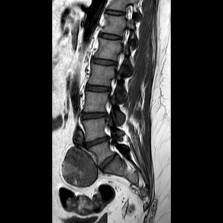 Pelvic Schwannoma Image Radiopaedia Org