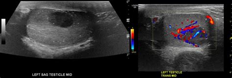 22 Year Old Male With History Of Seminoma In The Right Testicle