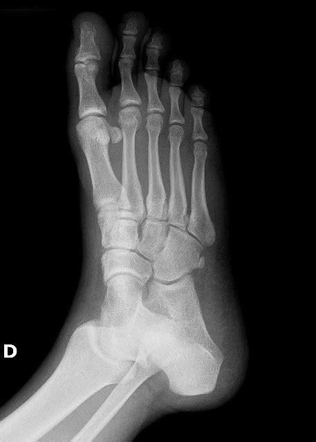 Accessory Bones Of The Foot Os Tibiale Externum And Os Peroneum