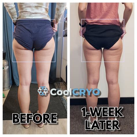 Coolcryo Reduce Fat Fix Cellulite And Tighten Skin Rapid City