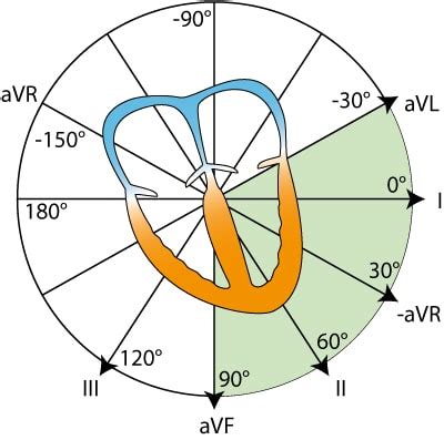 The Cabrera format of the 12-lead ECG & lead –aVR instead of aVR – ECG ...