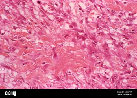 Fasciitis, light micrograph. Fasciitis is the inflammation of fascia ...