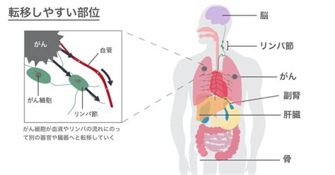 医師監修・作成 肺がんの手術はどんな手術？ Medleyメドレー