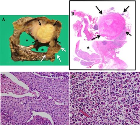 Pathological Findings Of Case 2 A Macroscopically The Main Tumor