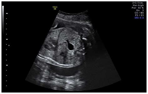 Fetal Ovarian Cyst Ultrasound