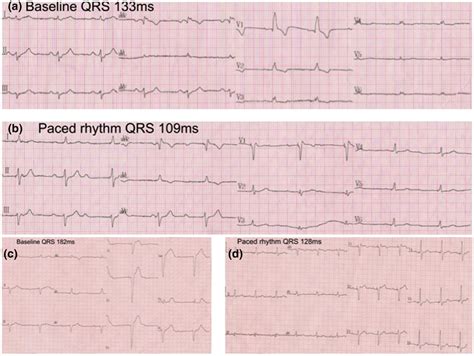 Electrocardiogram Before And After Left Bundle Zone Pacing LBBAP A