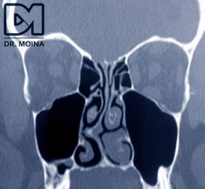 Rinoseptumplastia Tabique Nasal Desviado Desviacion Septal 4