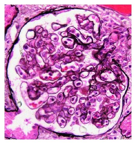 Glomerular Renal Biopsy Findings A Mesangial And Endocapillary