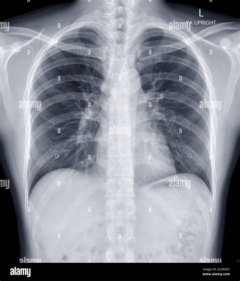 Radiografía De Tórax O Radiografía De Tórax Humano Para Diagnóstico De