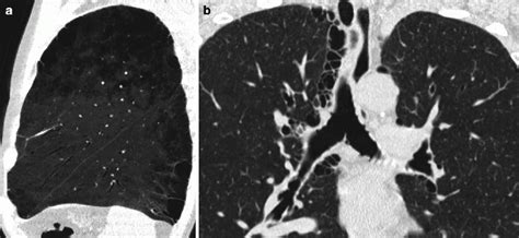 Diffuse Lung Diseases Radiology Key