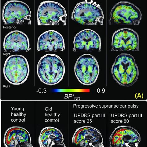 Brain MRI illustrative images of a patient with progressive ...