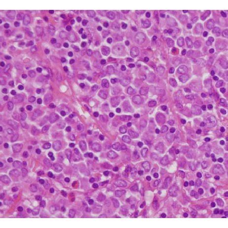 A CT Showing Left Periorbital Myeloid Sarcoma Arrowed B