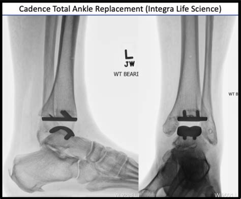 Ankle Replacement FootEducation