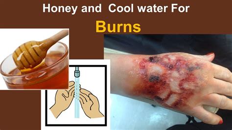 Home Remedies For Burns With Honey And Cool Water Youtube